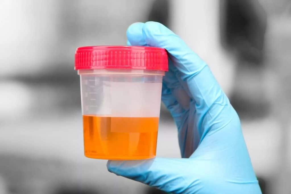 urine with blood in calculus prostatitis